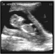 Baby Sonograph