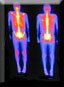 Whole body bone scan using Nuclear Medicine technology